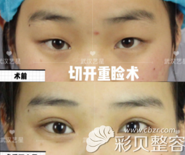 武汉Yestar艺星院长都志杰美杜莎双眼皮案例