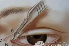 亲身经历告诉你双眼皮+开眼角术后疤痕增生0.5厘米多久消失