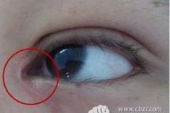 亲身经历告诉你双眼皮+开眼角术后疤痕增生0.5厘米多久消失