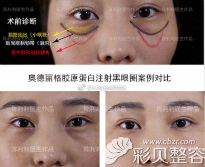 奥德丽格胶原蛋白注射去黑眼圈案例