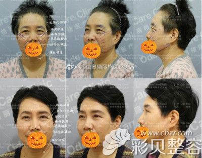 奥德丽格面部埋线提升案例手术恢复效果对比图