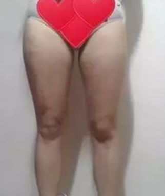 在北京米兰柏羽丽都整形做过面部脂肪+吸脂瘦小腿效果美翻了