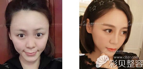 上海美莱王琳全切双眼皮一个月后的恢复效果