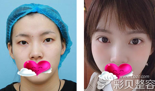 李鹏医生割双眼皮+开眼角案例图 李鹏医生割双眼皮+开眼角案例图