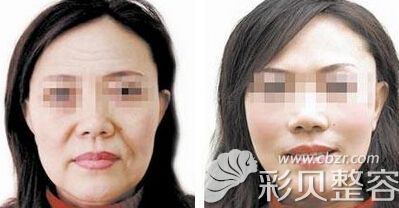 南京施尔美整形李彤彤拉皮手术面部年轻化案例图