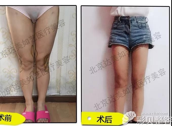 北京达美如艺国海军O型腿矫正效果怎么样