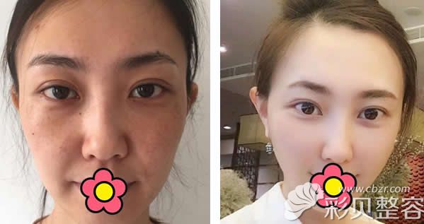 北京达美如艺谢洋春面部埋线提升真人案例