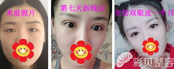 北京八大处靳小雷医生切开双眼皮一个月恢复过程