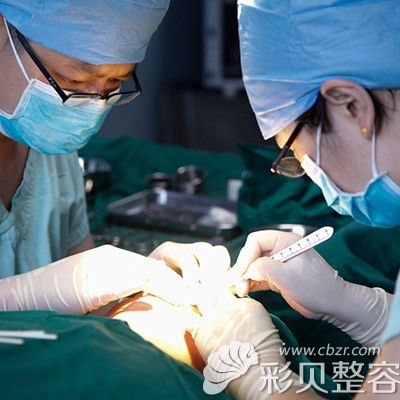 广州南珠蒋海军双眼皮手术过程