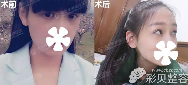 南京华美王小林双眼皮案例及一年后对比照