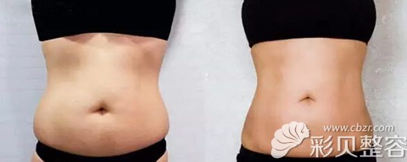 深圳希思美容整形腰腹部吸脂效果对比图