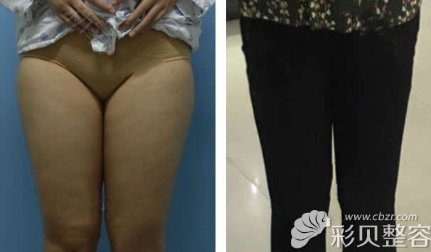 杭州时光吕敏院长大腿吸脂前后对比