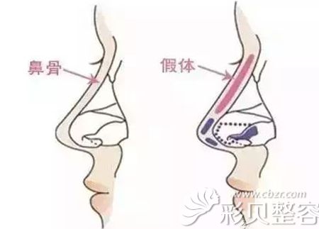 隆鼻手术常用到假体