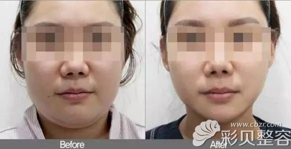 陈主任线雕提升改善双下巴的手术案例