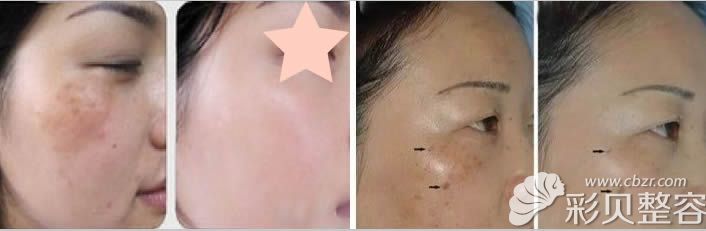 刘耿院长祛除黄褐斑代表案例图