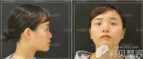 北京柏丽李劲良综合隆鼻术前