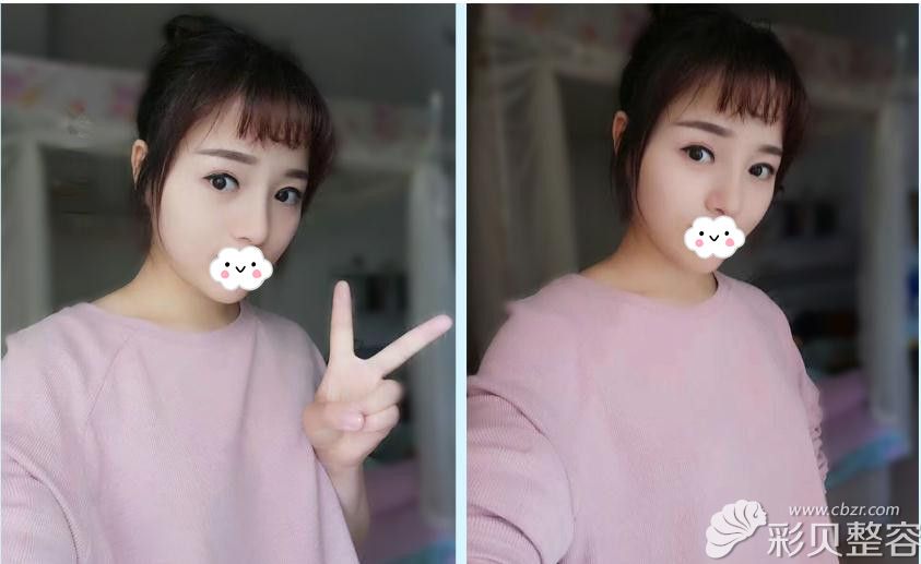 北京柏丽李劲良综合隆鼻术后