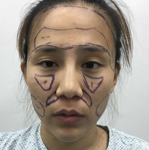 我在北京叶美人做了自体脂肪面部填充+注射隆鼻 效果很精致