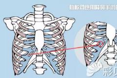 上海喜美隆鼻医生王会勇专业解析肋软骨隆鼻会被吸收吗？