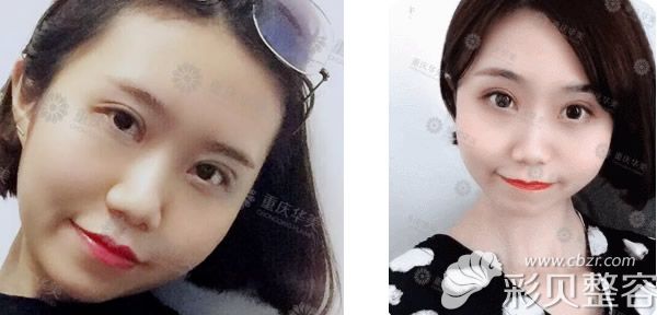 重庆华美切开双眼皮+开眼角术后一个月