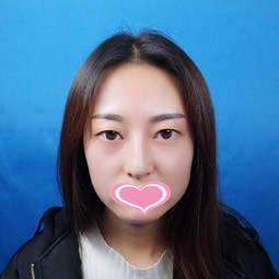 长沙美莱整形医院刘欢割双眼皮好不好？看我真实案例对比