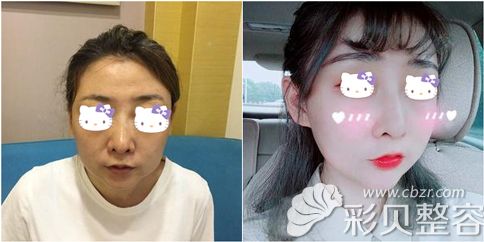 北京奥德丽格王志军面部年轻化术后效果