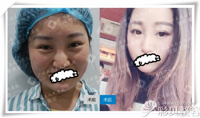 广州荔湾人民医院整形科隆鼻+下巴奥美定取出修复案例前后效果图