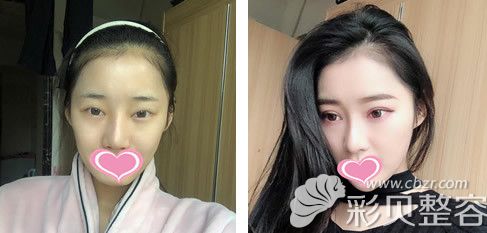 长沙美莱整形刘欢医生全切双眼皮术后65天真实案例对比照