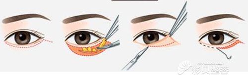 外切法祛眼袋手术过程