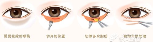 内切法祛眼袋手术过程
