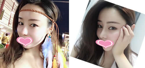 想做假体隆鼻 先看我找长沙美莱整形医院周文亮术后的案例