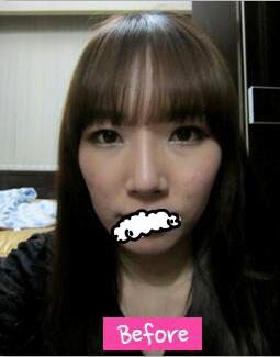 韩国profile面部轮廓整形真实案例对比，术后变化惊艳到我了