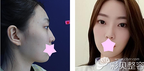 鼻综合+耳软骨隆鼻效果对比图