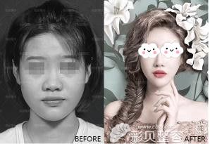 李劲良医生所做的鼻综合案例 李劲良医生所做的鼻综合案例