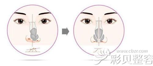 歪鼻矫正手术术后效果示意图