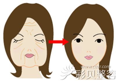 拉皮手术是面部除皱的好方法
