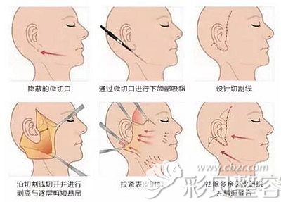 北京解放军309张亚洁对拉皮手术的过程解析