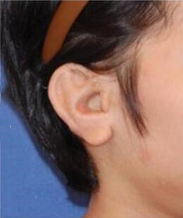 耳畸形同伴分别找韩国Profile郑在皓和李好基做耳朵整形案例
