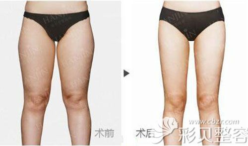 昆明韩辰陈宁院长大腿吸脂案例对比效果