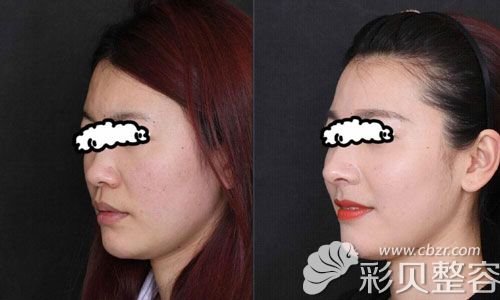 昆明韩辰胡乔隆鼻案例效果对比