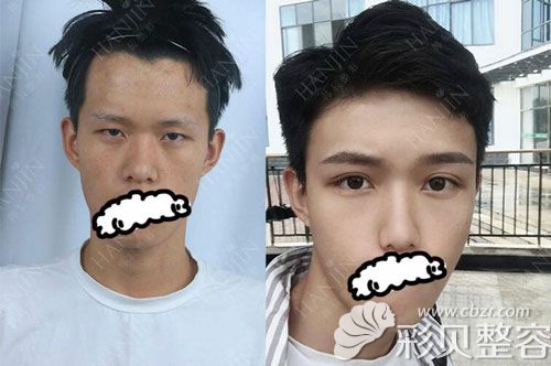 昆明韩辰王德宁医生双眼皮案例效果展示