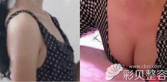 北京叶美人程志伟自体脂肪隆胸案例效果对比图