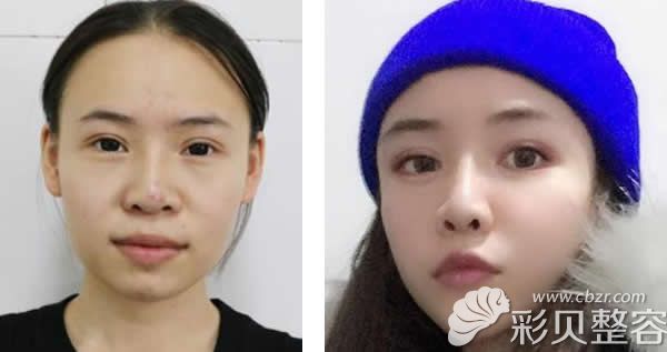 北京金燕子马铁安玻尿酸隆鼻+全脸脂肪填充真人案例