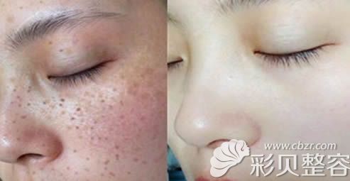 雀斑前后祛除效果对比图