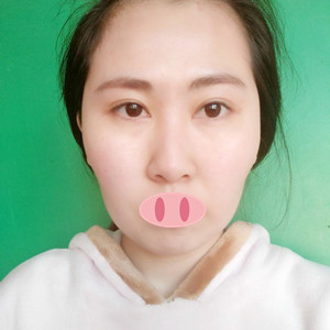 找深圳伊婉整形柳大烈做颧弓磨骨术后超满意 跟脸大说拜拜