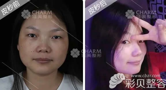 南昌佳美整形医院余群医生超皮秒激光祛斑效果案例