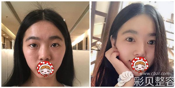 北京亚馨美莱坞张海明做欧式双眼皮恢复效果对比图