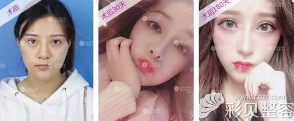 南昌佳美张效恩肋软骨综合隆鼻案例