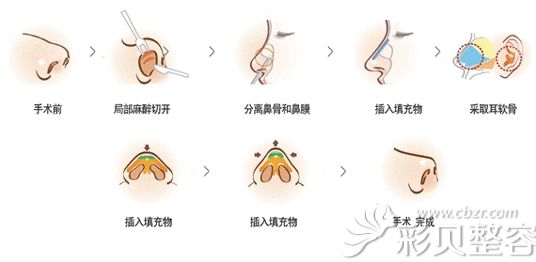 耳软骨隆鼻的手术步骤简易图