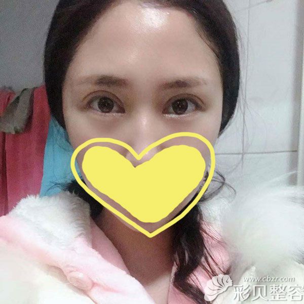 来看看我到上海艺星做双眼皮术后14天效果